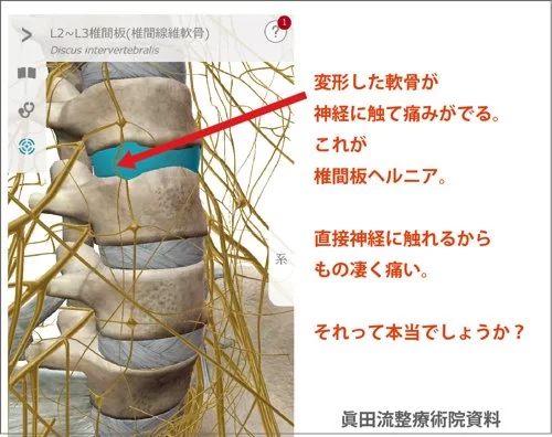 広島でヘルニア治療の有名整体院が解説-ヘルニア誤診例