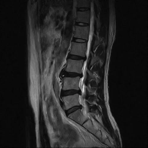 広島でヘルニア治療の有名整体院が解説-ヘルニア誤診例