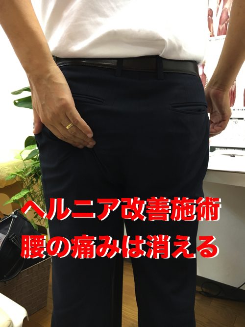 広島で椎間板ヘルニアの治療で有名な整体院の記録-腰の痛みが消えて治った例1