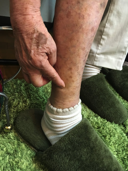 整形外科で治らない脊柱管狭窄症の原因と治療方法-広島の整体院の治った例