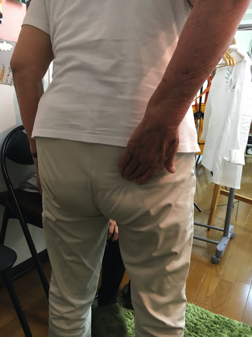 整形外科で治らない脊柱管狭窄症の原因と治療方法-広島の整体院の治った例