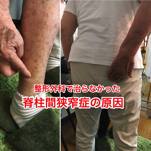 整形外科で治らない脊柱管狭窄症の原因と治療方法-広島の整体院の治った例