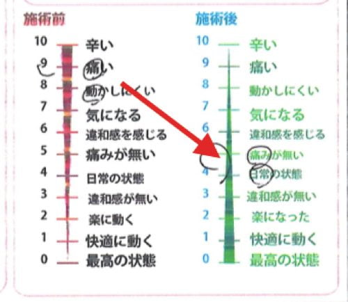 椎間板ヘルニアと脊椎狭窄症の原因と治療方法-広島で椎間板ヘルニア治療で有名な整体院の記録4