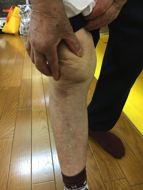 歩くのも辛い膝の痛みを治す_広島で変形性膝関節症や膝の水たまり治療専門の整体院