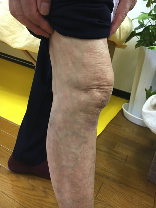 歩くのも辛い膝の痛みを治す_広島で変形性膝関節症や膝の水たまり治療専門の整体院