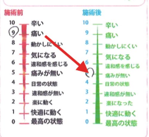 脊椎狭窄症の腰の痛みと足のシビレの原因と治療方法_広島の有名な腰痛専門の整体院の治った霊7